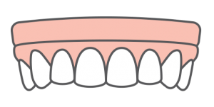 Implant Dentures