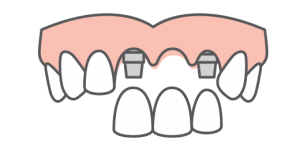 Replace multiple teeth